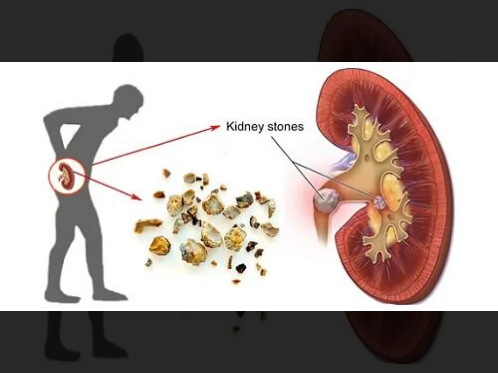 Batu Ginjal Nyeri? 4 Penyebab Rahasia yang Bikin Kamu Kaget – Nomor 1 Genetik!